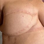Tejido autologo de espalda unilateral